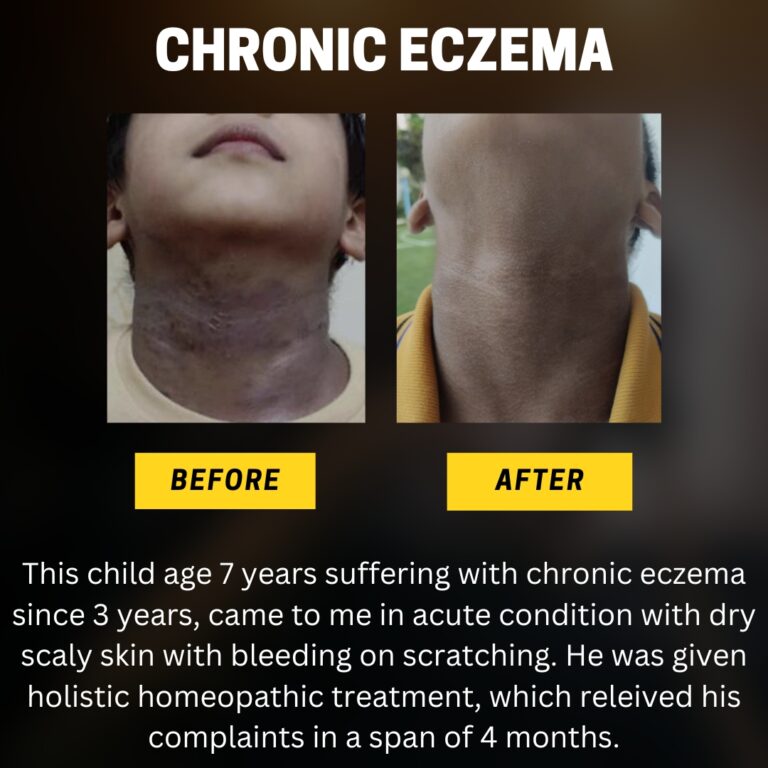 Chronic eczema