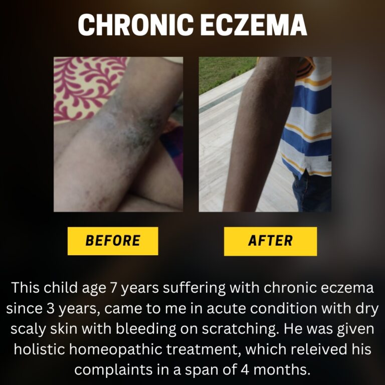 Chronic eczema