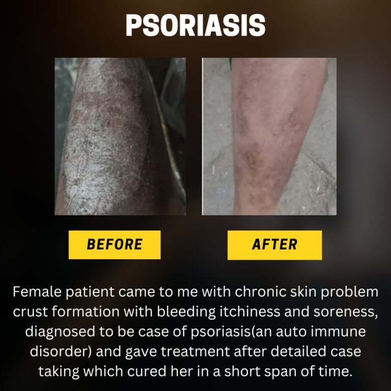 PSoriasis